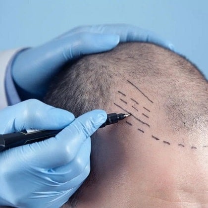 Is a Hair Transplantation Right for Me?